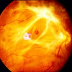 Диабетна ретинопатия симптоми, лечение, причини