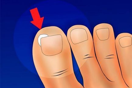 Ефективното лечение на гъбична нокът на палеца на крака и ръце