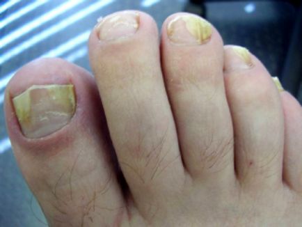 Ефективното лечение на гъбична нокът на палеца на крака и ръце
