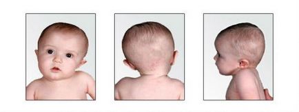 Хипертонични на мускулите на гърба и шията, лицето, дъвкателните мускули при възрастни и деца