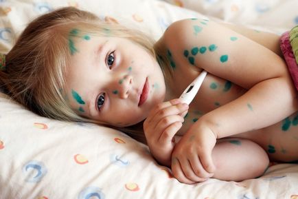 Как за лечение на варицела при деца ние се отървете от обрив и сърбеж