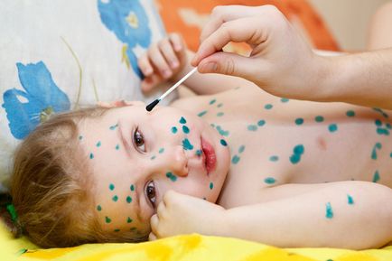 Как за лечение на варицела при деца ние се отървете от обрив и сърбеж
