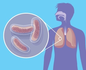 Как да се идентифицират туберкулоза у дома първите признаци и симптоми