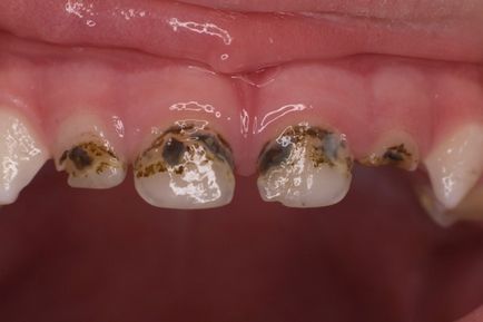 Кариес млечни зъби - причини и методи на лечение