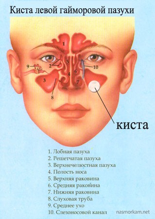 Киста в носа (назални синуси) симптоми, лечение, последици