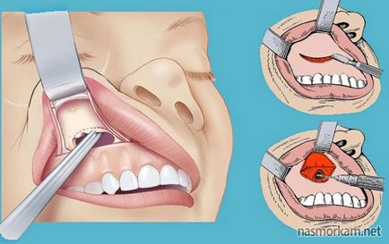 Киста в носа (назални синуси) симптоми, лечение, последици