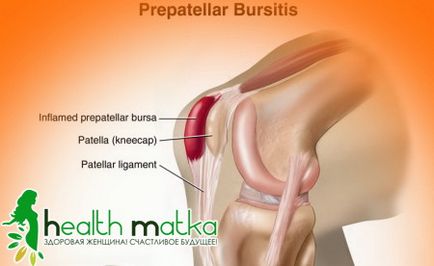 Методи за лечение на бурсит на колянната става