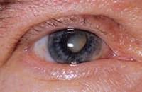 Tic очите причини и лечения