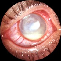 Нистагъм око, които са симптоми, причини и лечение на болестта