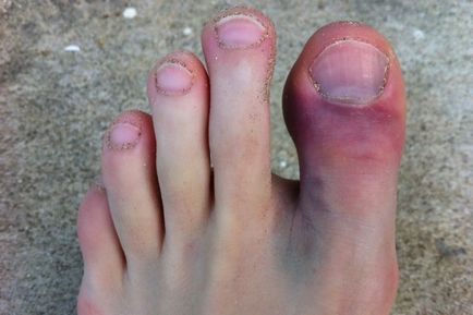 Счупване на големите симптоми на пръстите на краката, първа помощ, лечение, диагностика