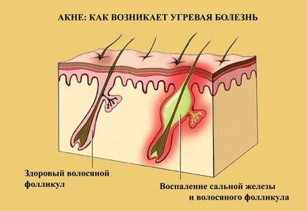 Акне на гърба на мъжете и жените - причини и лечение (акне) Акне на гърба на мъжете и жените - причини и лечение