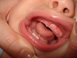 Изригване на кучешките зъби на децата в симптомите, какво да направите, ако зъбите на изкачване на очите