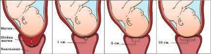 Симптоми и признаци на дилатация по време на бременността и преди раждането