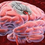 Симптомите на мозъчното кръвообращение - скалпел - медицинска информация и образование