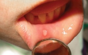 Стоматит в устата причинява симптомите, диагностика и лечение,