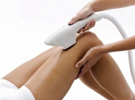 Премахване на космите на краката - само тези методи помагат да се отървете от косата на краката!