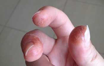 Вреден при нокти гел за нокти - увреждане на състава като вредно за неговата постоянна употреба