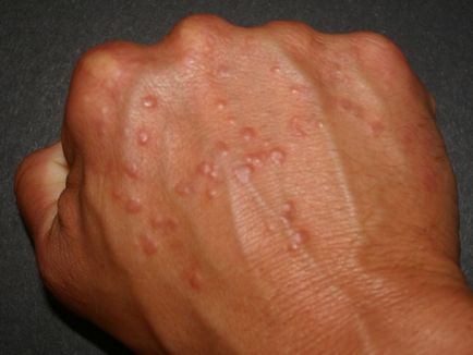 Allergy на ръка под формата на мехурчета - лечение и