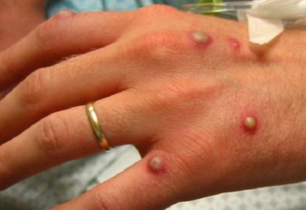Allergy на ръка под формата на мехурчета - лечение и