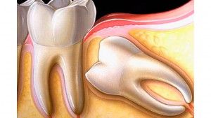 Distopirovannyh зъб мъдрост отстраняване зъб на повлияха