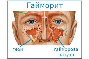 Синузит симптоми при възрастни и при лечението на първите признаци и симптоми