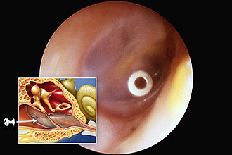 Гнойни възпаления на средното ухо при деца - симптоми и лечение на деца
