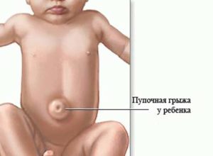 Херния в новородено симптоми, лечение и превенция