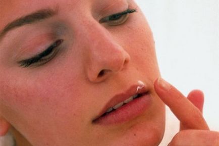 Как за лечение на херпес на устните на подробен преглед на различните ефективно средство