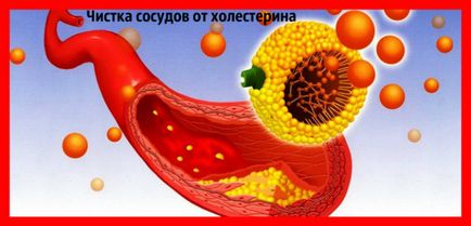 Как да се чисти съдове в мозъка на холестерола (съдове) Как да се чисти на съдовете на мозъка от холестерол