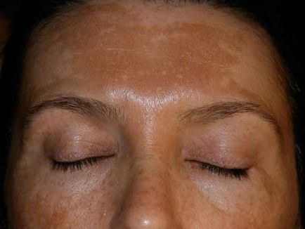 Как да премахнете тъмни петна по лицето, бързо и трайно