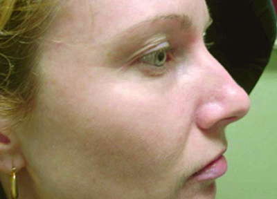 Как да премахнете тъмни петна по лицето, бързо и трайно