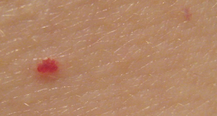 Червени петна по тялото снимка, причини, лечение, кожни заболявания
