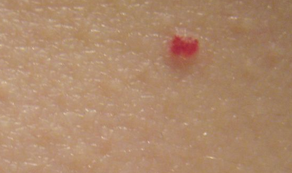 Червени петна по тялото снимка, причини, лечение, кожни заболявания