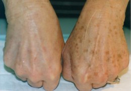 Calluses на ръцете причини и начини за борба с
