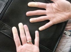 Numb дясна ръка - Причини