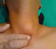 Нормално размер на щитовидната жлеза чрез ултразвук