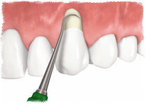 Изложение на гърлото на зъб - причини и лечение, всички на зъбите