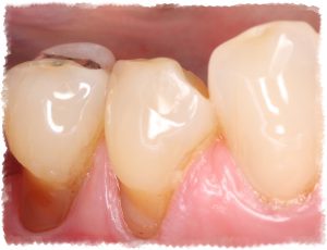 Изложение на гърлото на зъб - причини и лечение, всички на зъбите