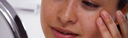 Кафяви петна по лицето - причини и лечение