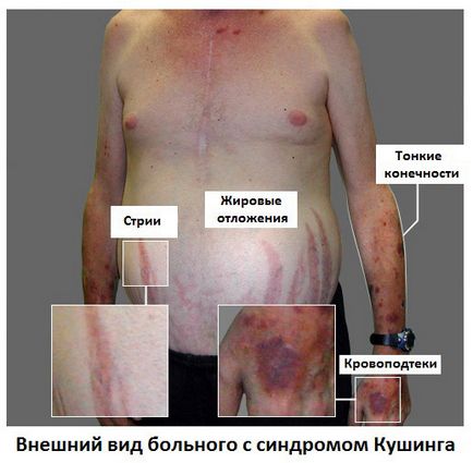 Какви са причините за стрии лечение на стрии по време на бременност, как да премахнете стрии