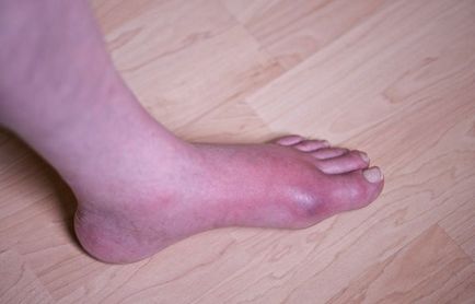 Подагра в краката причинява симптомите, диагностика, лечение, които са компетентни за здравето на ilive