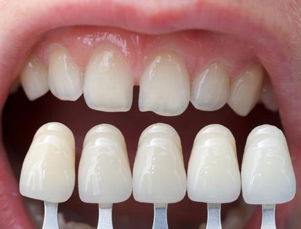 Нека поговорим за това как да се приведе в съответствие зъбите у дома