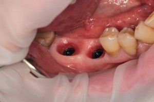 Зъбни протези нови съвременни технологии и видове