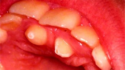 Повлияха зъби и дистопичния него и дали отстраняването е необходимо