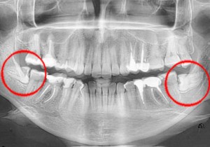 Повлияха зъби и дистопичния какво е то и как да се реши