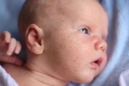 Обрив по лицето на новородено бебе до 1 месец