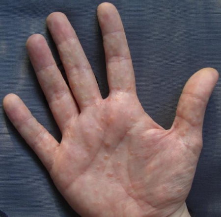 Обрив на ръка под формата на мехурчета Лечение