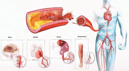 Множествена склероза сърцето аорта - описание, симптомите и лечението
