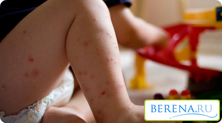ухапване от комар при децата, лекувани
