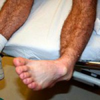 Разместване на краката - лечение у дома, оказване на първа помощ, какво да правя